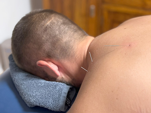 Dry needling